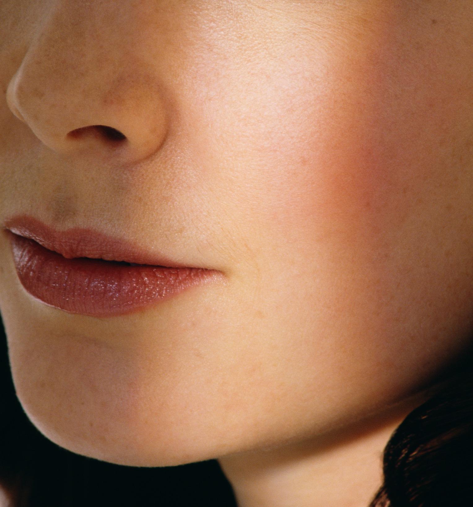 Laser Facial Treatments