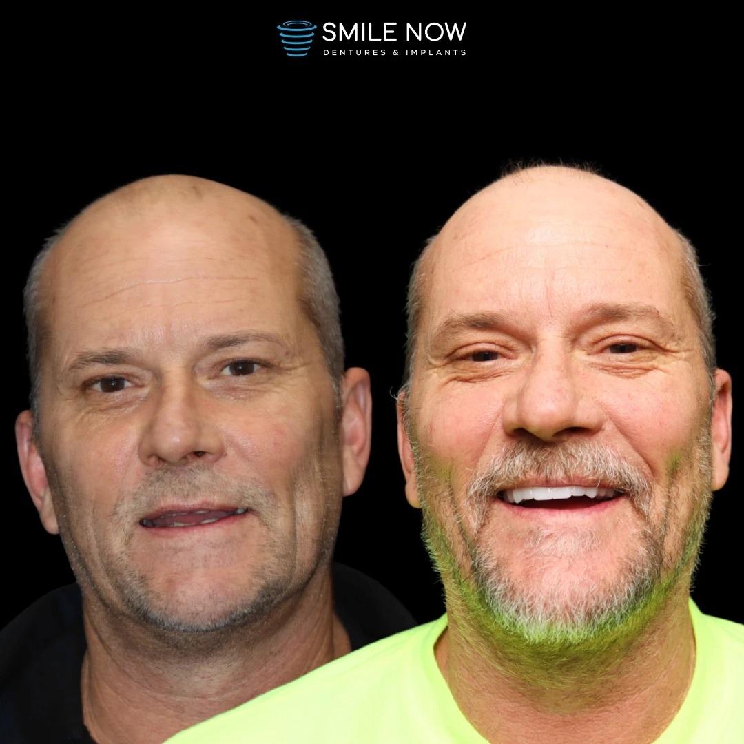 Smile Now Boise Dentures and Implants Image