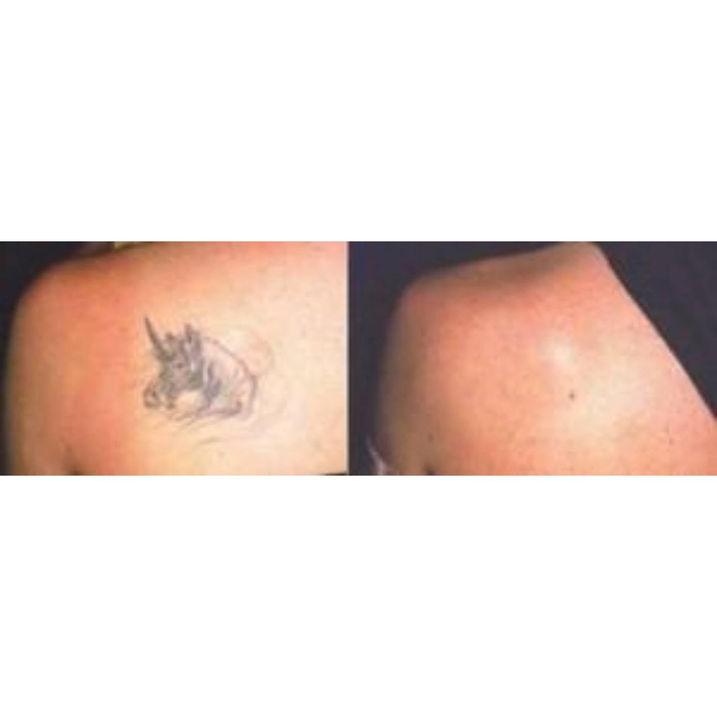 Mark Rileys Tattoo Removal - Tattoo Removal in Rochford SS4 3QA 