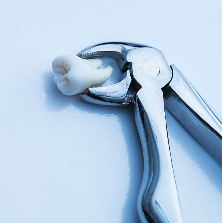 Tooth Extraction