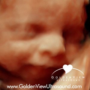 3d/4d HDLive Ultrasound photo captured at GoldenView Ultrasound