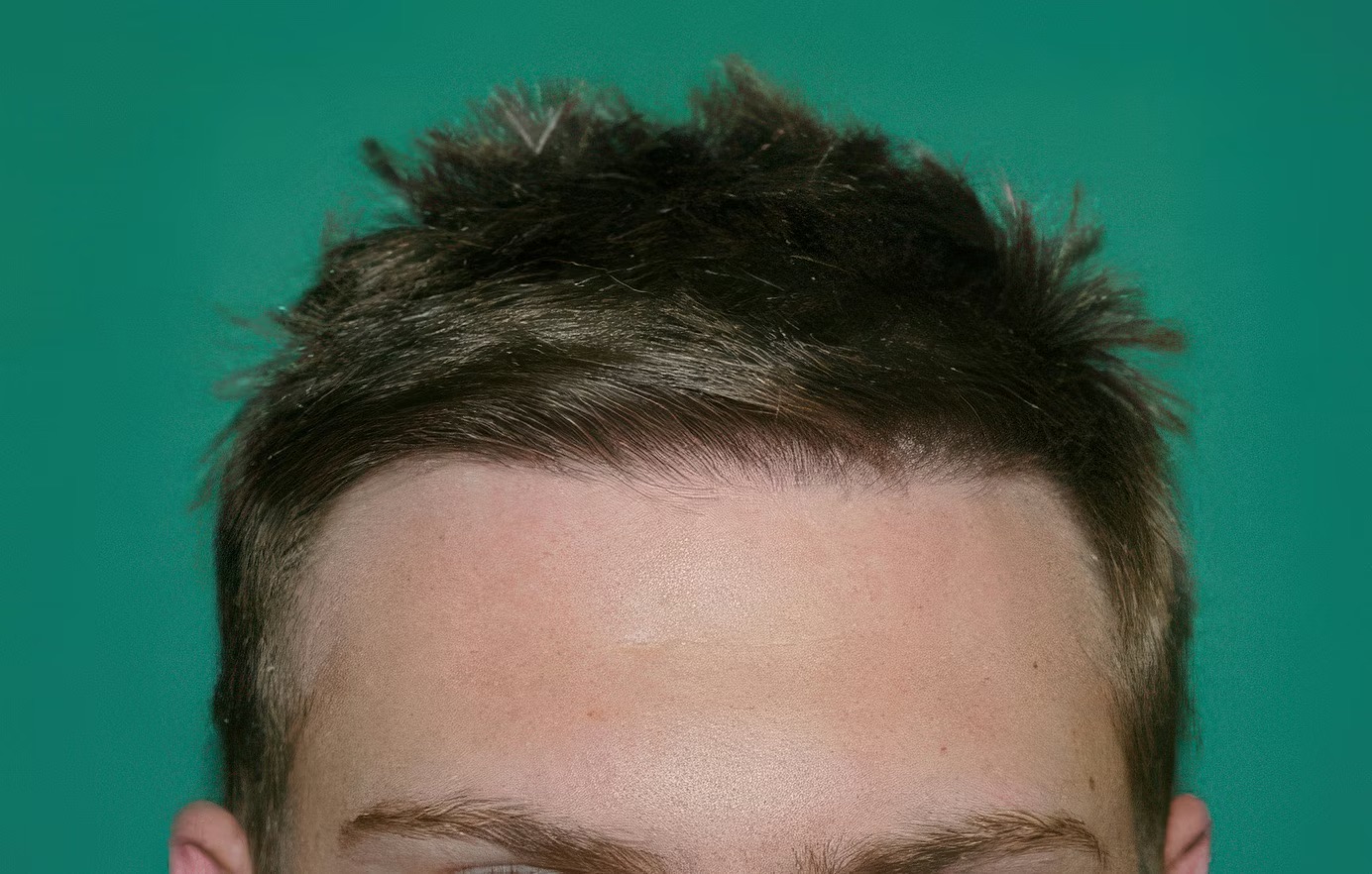 Hair Loss Treatment