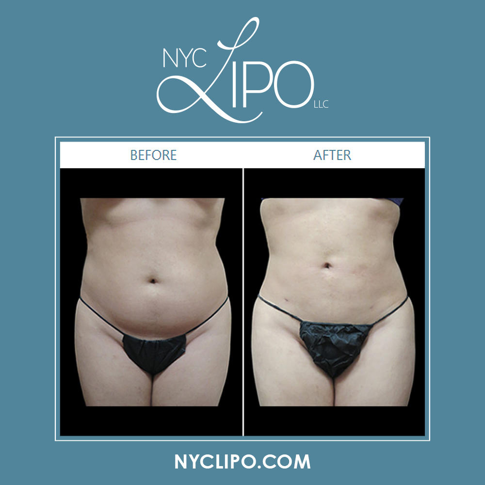 NYC Lipo LLC Photo