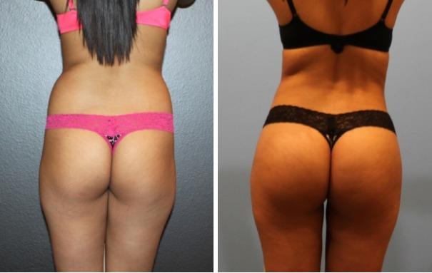 Denver Liposuction Specialty Clinic Photo