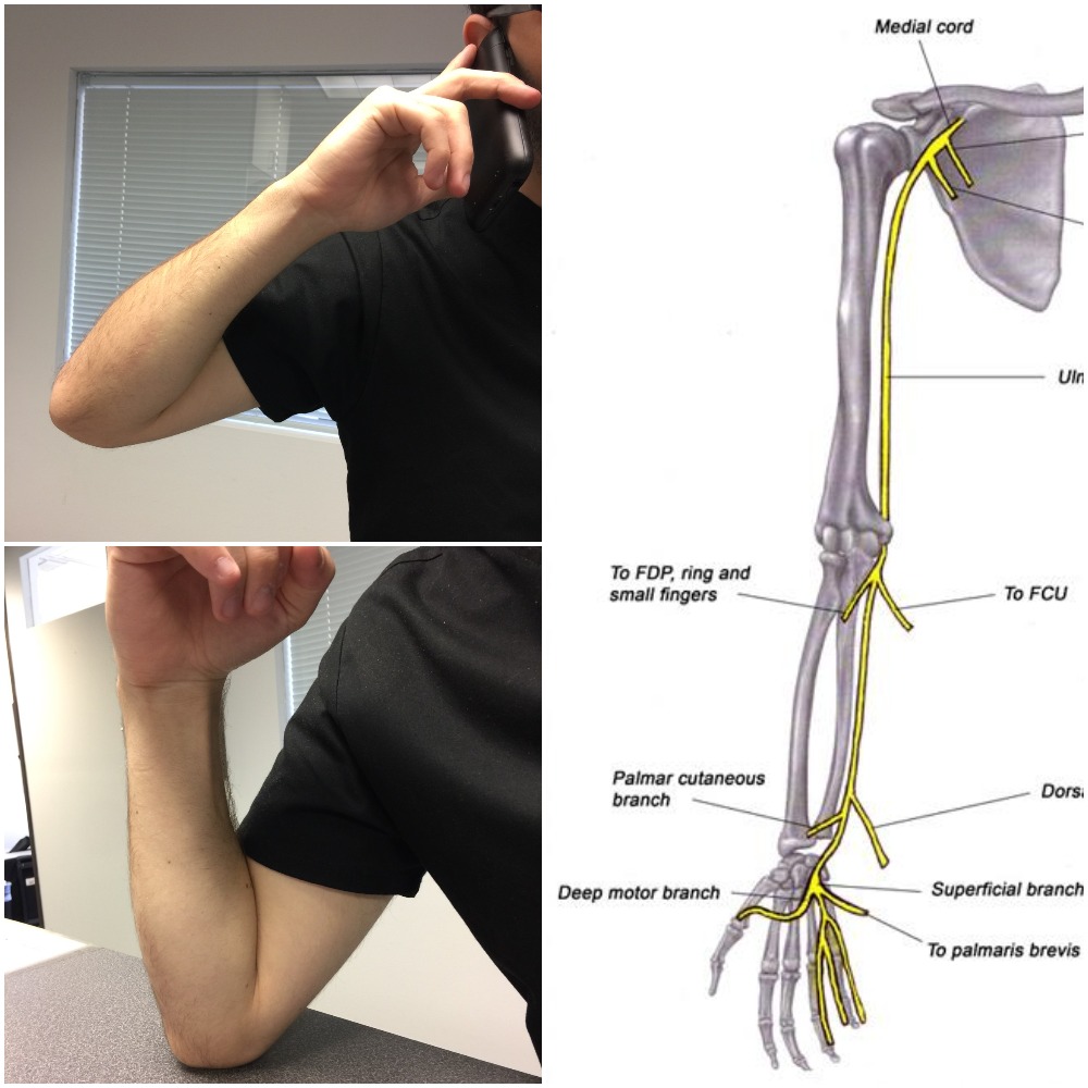 Cubital Tunnel Syndrome is a condition that involves either stretching or pressure of the ulnar nerve at the elbow. The ulnar nerve runs down from the shoulder down towards the elbow in front of the funny bone (olecranon) and continues between the muscles in the forearm and inside the hand giving sensation to the little finger and half of the ring finger, inside the palm and backside of the hand. If along the nerve there is pinching, pressure, stretching or anatomical changes this nerve may become affected giving signs and symptoms of pain, tingling sensation, loss of sensation or weakness in the hand. Common causes of Cubital Tunnel Syndrome is fracture at the elbow, which later after healing could push on the ulnar nerve; excessive bending of the elbow, such as sleeping with your elbow bent or answering phone calls or leaning on your elbow for long periods of time. In order to potentially reduce the symptoms, try sleeping with your elbow straight, not bending and leaning on your elbow and avoiding excessive, repetitious activities that require bending of the elbow. If the pain and numbness persist, the nerve may need to be examined. Ask your Primary Physician for a referral to an Electrodiagnostic Specialists for a nerve test (EMG/NCS). California Sports & Rehab Center can accommodate your needs in our multiple locations in the Los Angeles and Orange Country areas. Please visit us at http://emg-ncv.com or call our office at (310)-652-6060 to schedule an appointment today!