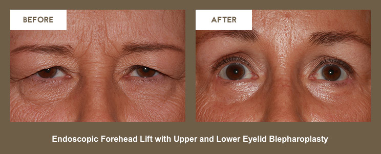 Klapper Eyelid and Facial Plastic Surgery Photo