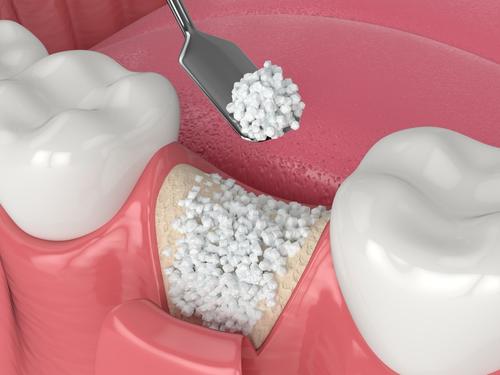 Bone Grafting & Ridge Preservation