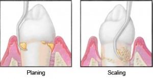 Gum Treatment