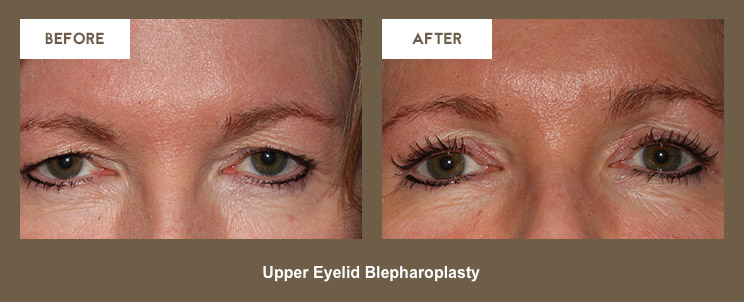 Klapper Eyelid and Facial Plastic Surgery Photo