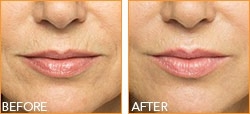 Fillers