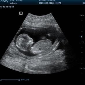 Baby Bee 3D Ultrasound (Fort Worth/NRH)