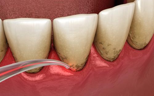 Gum Disease Treatment