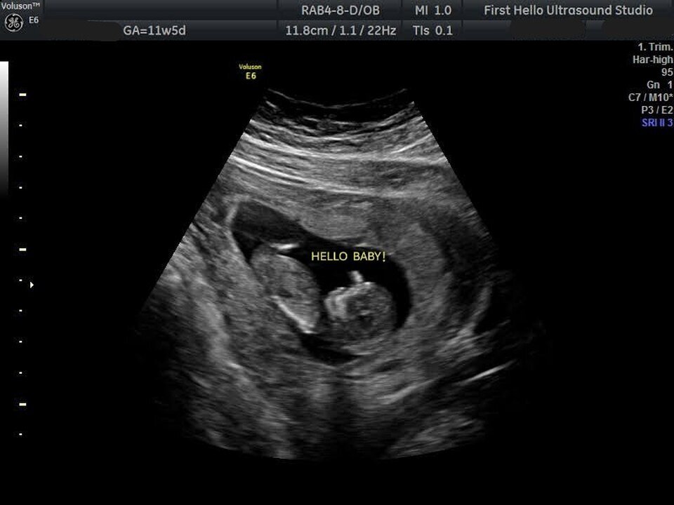 First Hello Ultrasound Studio