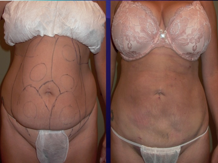 Tickle Lipo