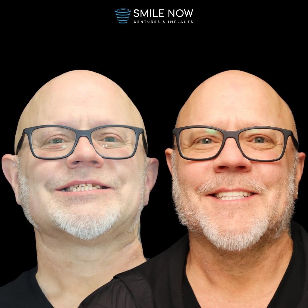 Smile Now Boise Dentures and Implants Image