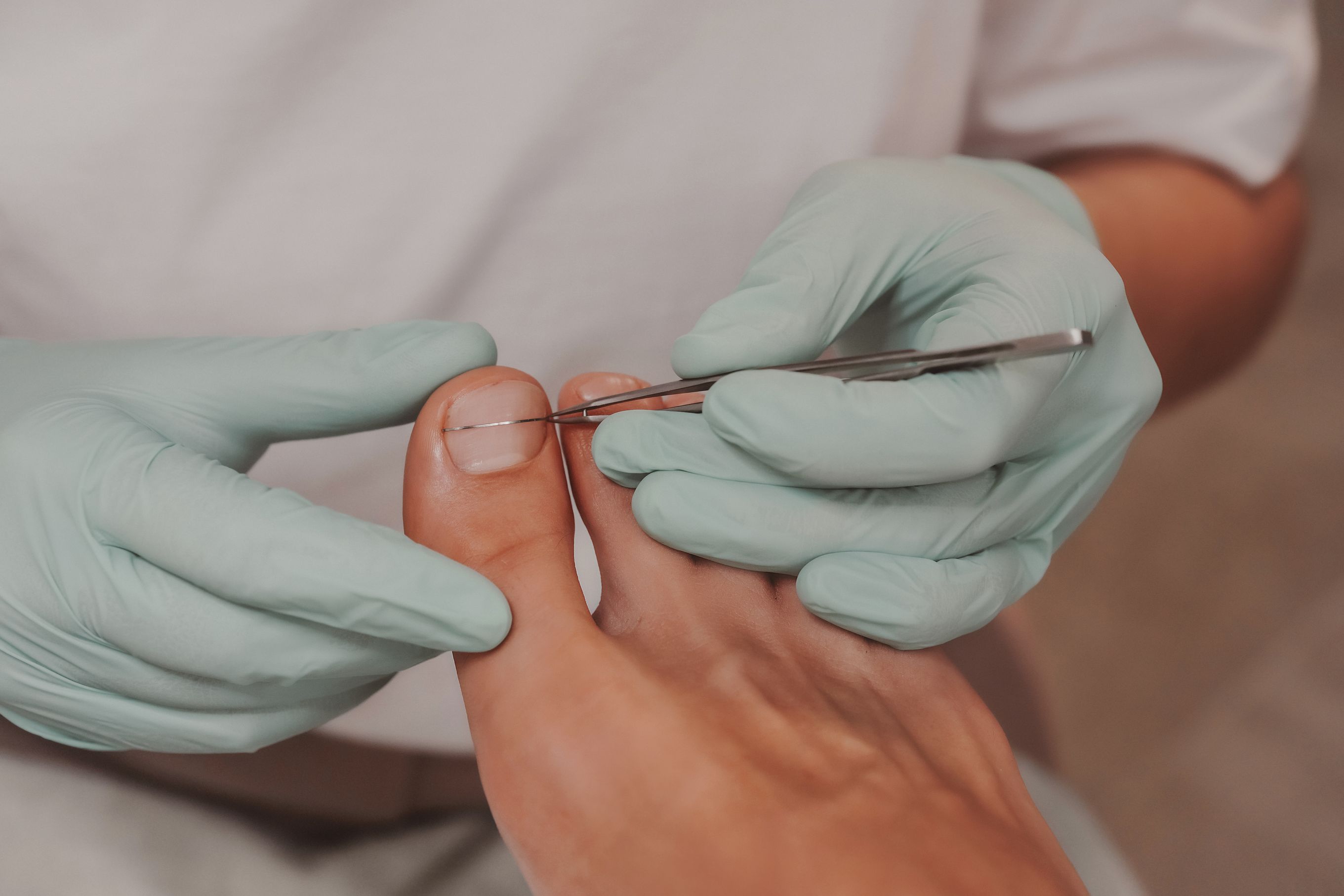 Orthonyxie (Spangentherapie)