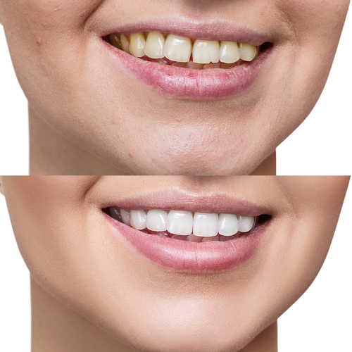 Porcelain Veneers