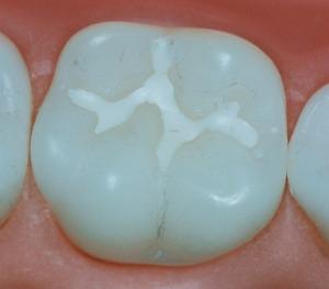 Fissure Sealants