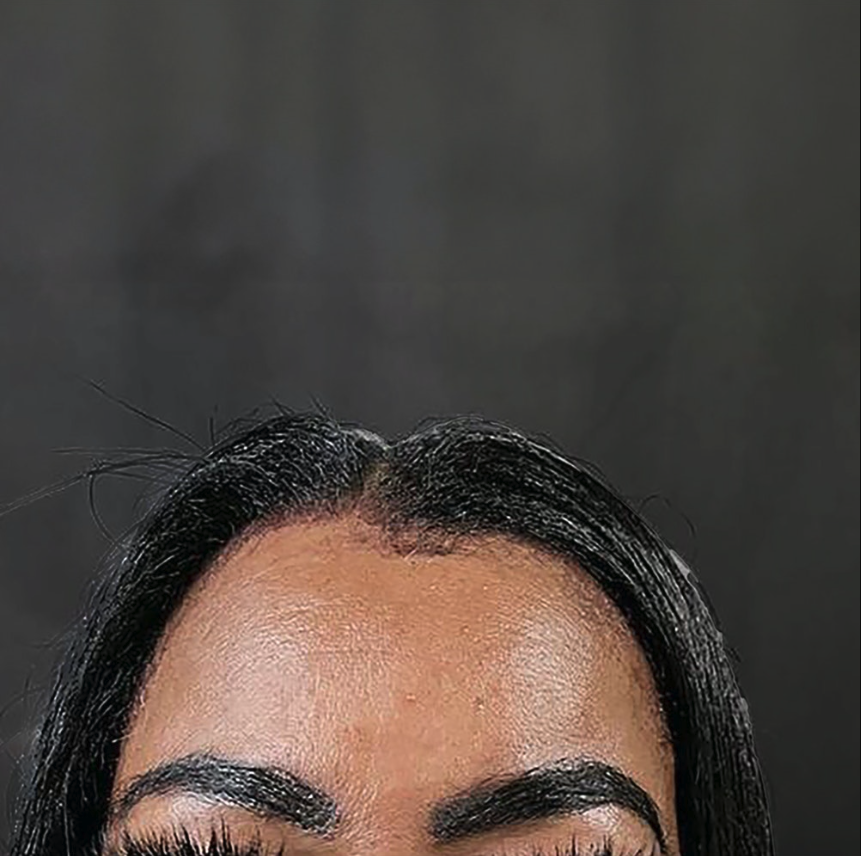 Eyebrow Transplant
