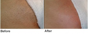 Laser Hair Removal