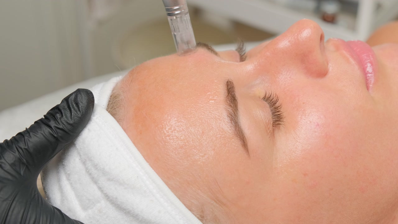 Microneedling