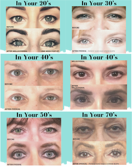 Blepharoplasty