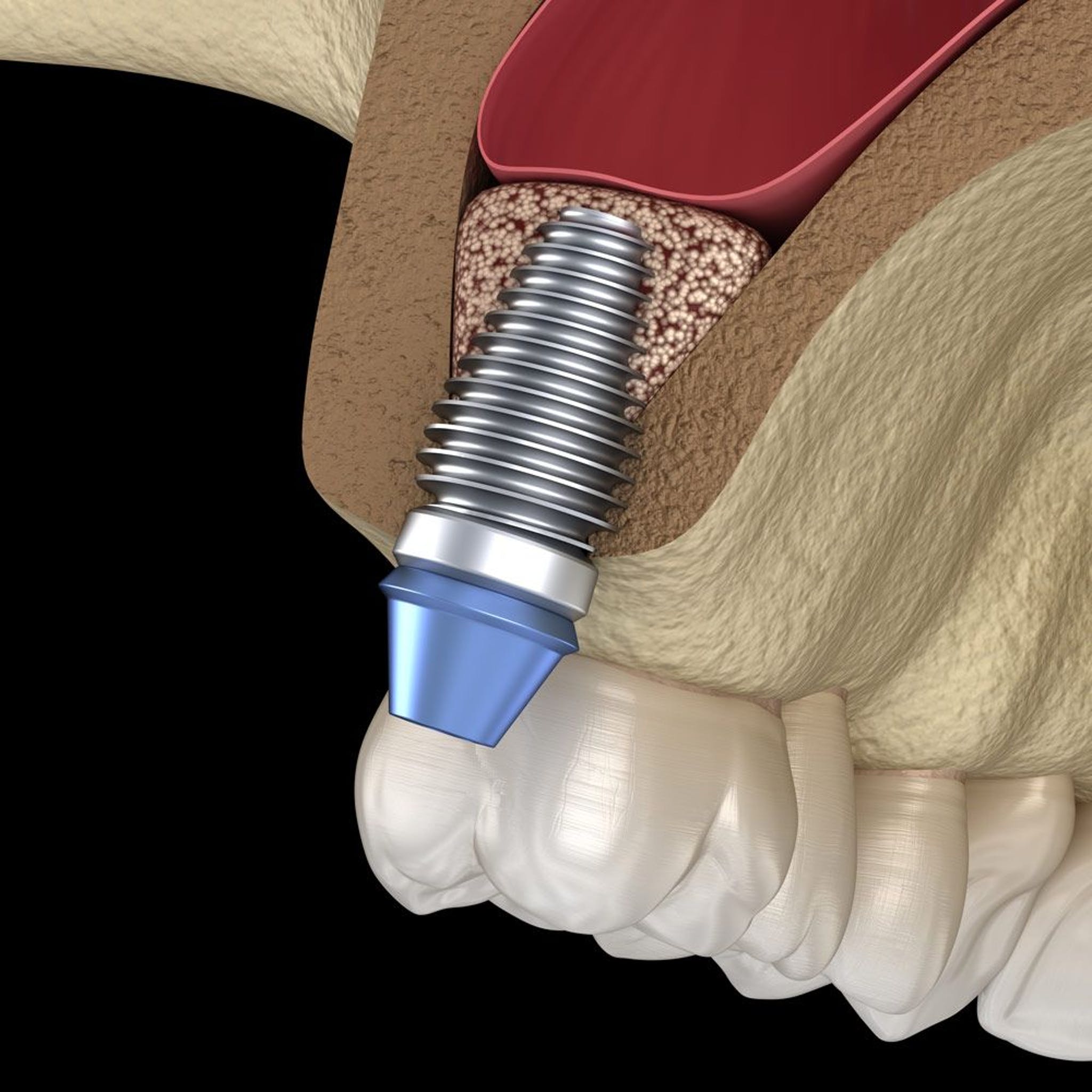 Sinus Lift