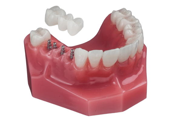Dental Bridges