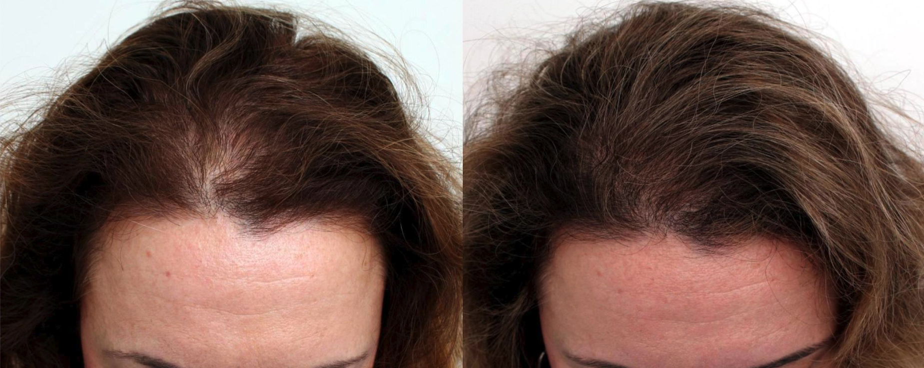 Hair Loss in Women