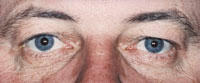 Droopy Eye