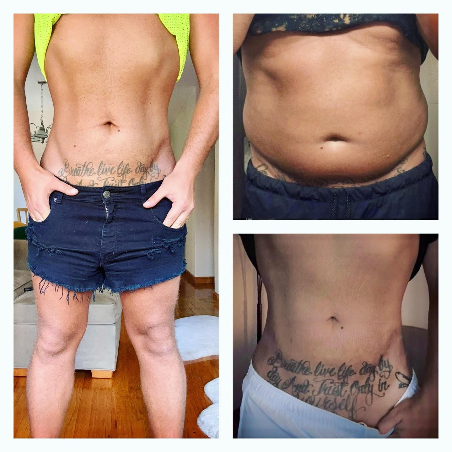 BodyLuxe | FormSculpt Awake Liposuction & Fat Transfer by Daniel J Farrugia MD PhD FACS Image