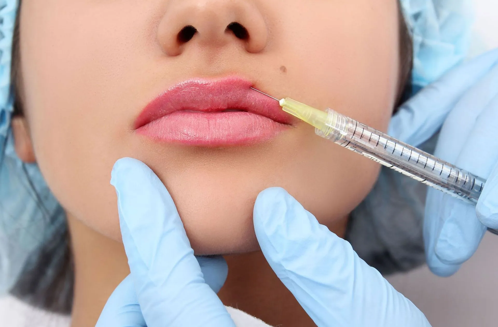 Dermal Fillers
