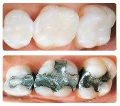 Regular & White Fillings