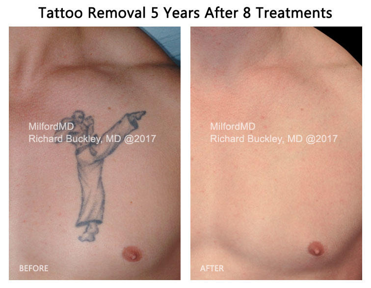 Tattoo Removal
