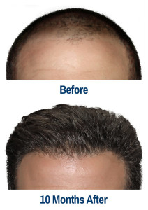 Minimally Invasive Hair Restoration Services