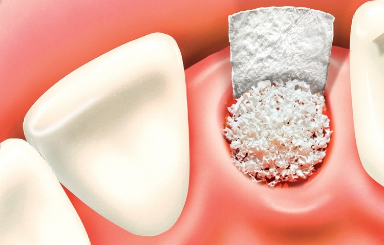 3 Calcium Phosphate Compounds In Maxillofacial Surgery