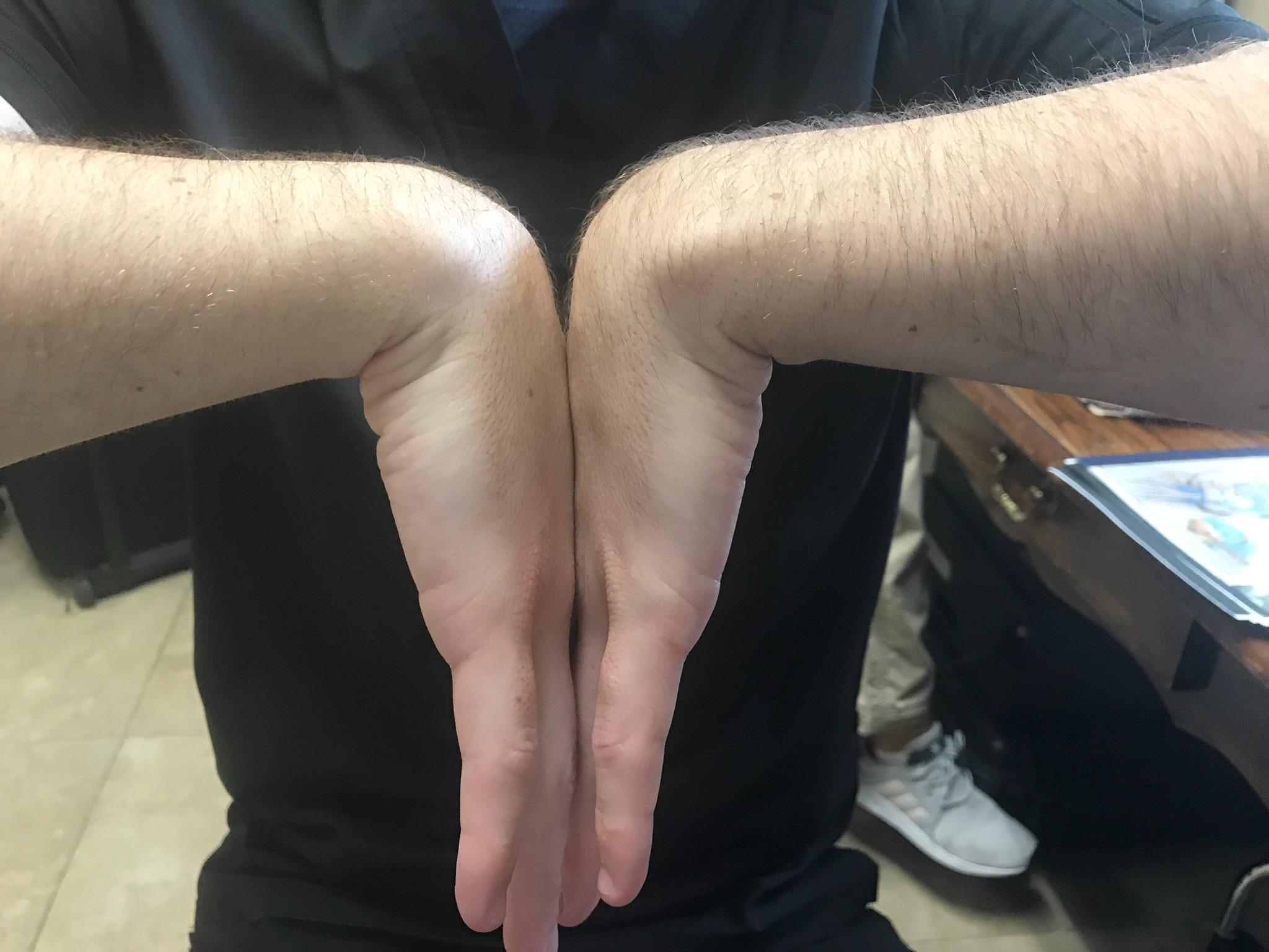 Carpal Tunnel Syndrome is a condition in which the median nerve travelling through the wrist is compressed or squeezed. This nerve is surrounded by ligaments, tendons and bones that may thicken and enlarge due to many factors. These factors include either repetitive hand use, hand and palm positions that involve flexing and extending, pregnancy, genetics, carrying heavy objects or other medical conditions such as obesity, hypothyroidism, diabetes or rheumatoid arthritis. Signs and symptoms of Carpal Tunnel Syndrome start gradually leading to numbness, tingling and pain sensation in the thumb, index, middle and ring fingers. An individual may also experience a weakened hand grip, loss of feeling in the fingers and a loss of coordination in the hand. If an individual continues to experience any of these signs or symptoms, they should be seen by a specialist in the field of Electrodiagnostic Medicine, http://emg-ncv.com, (EMG/NCS). An examination involving Phalen's test and Tinel's sign will be implemented to further confirm Carpal Tunnel Syndrome.  For additional information, you can contact California Sports & Rehab Center. We can accommodate your needs in multiple locations in the Los Angeles and Orange County areas. Please visit us at http://emg-ncv.com or call our office at (310)-652-6060 for any questions!