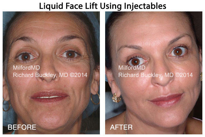 Injectables