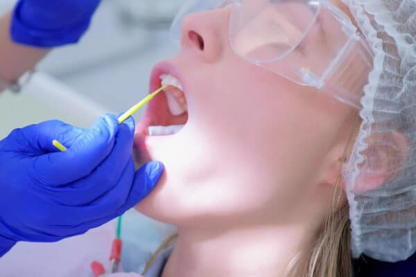 Dental Sealants
