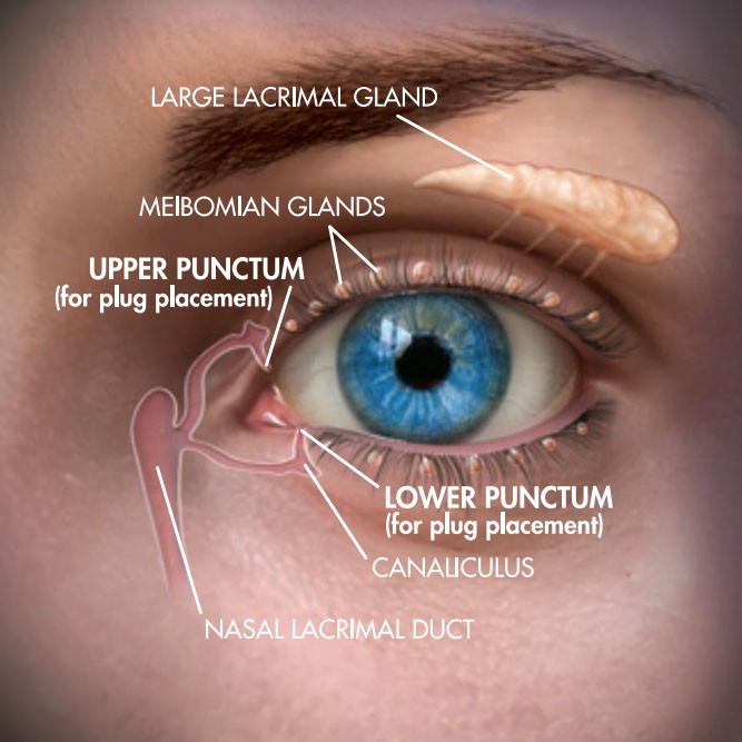 Dry Eye | Punctal Occlusion
