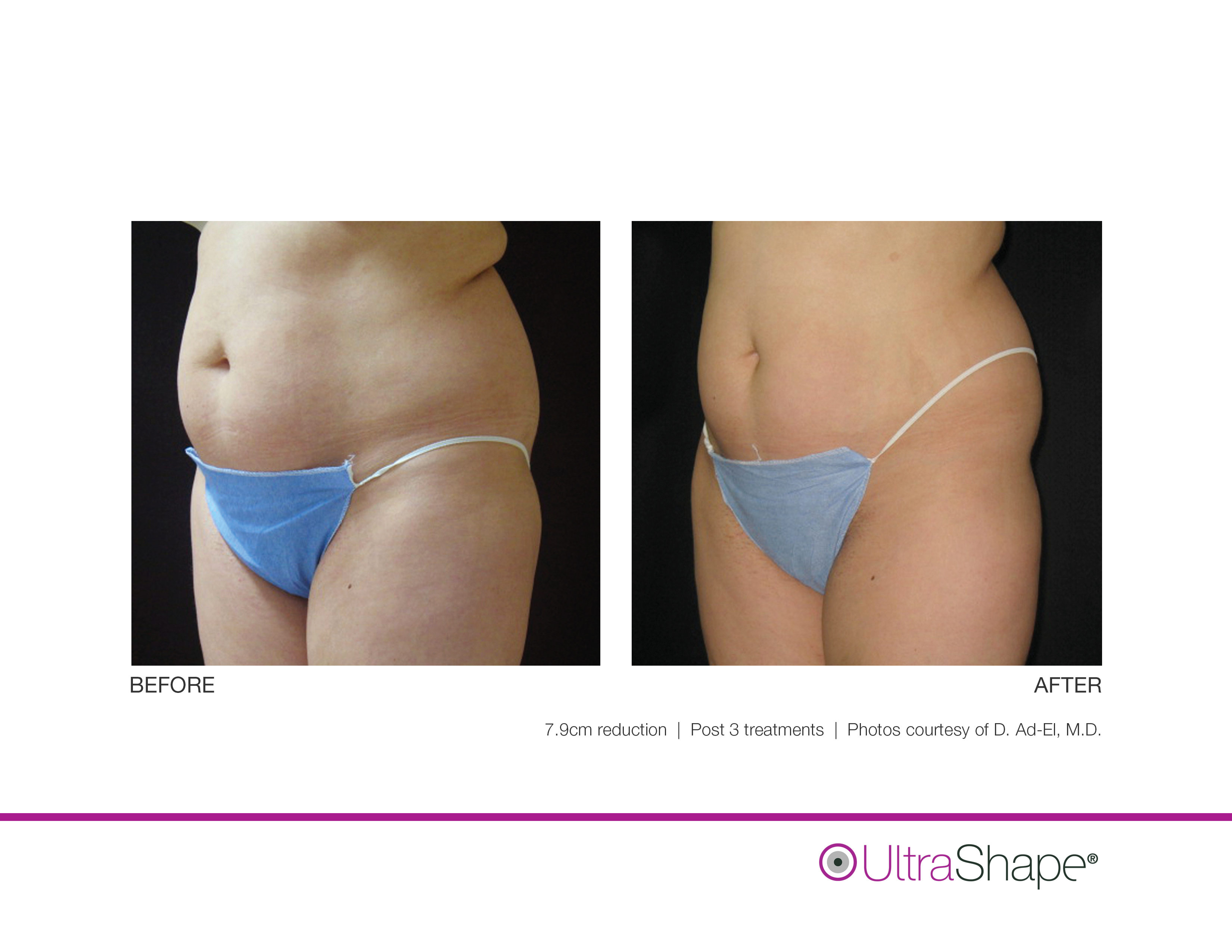 UltraShape