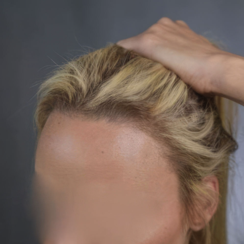 Hair Transplant