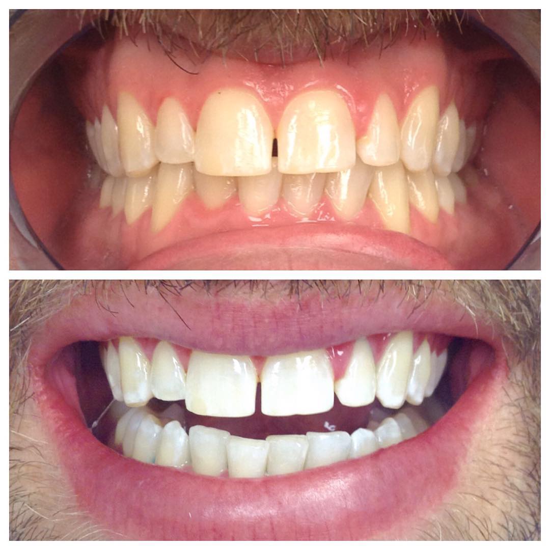 5280 Teeth Whitening Photo