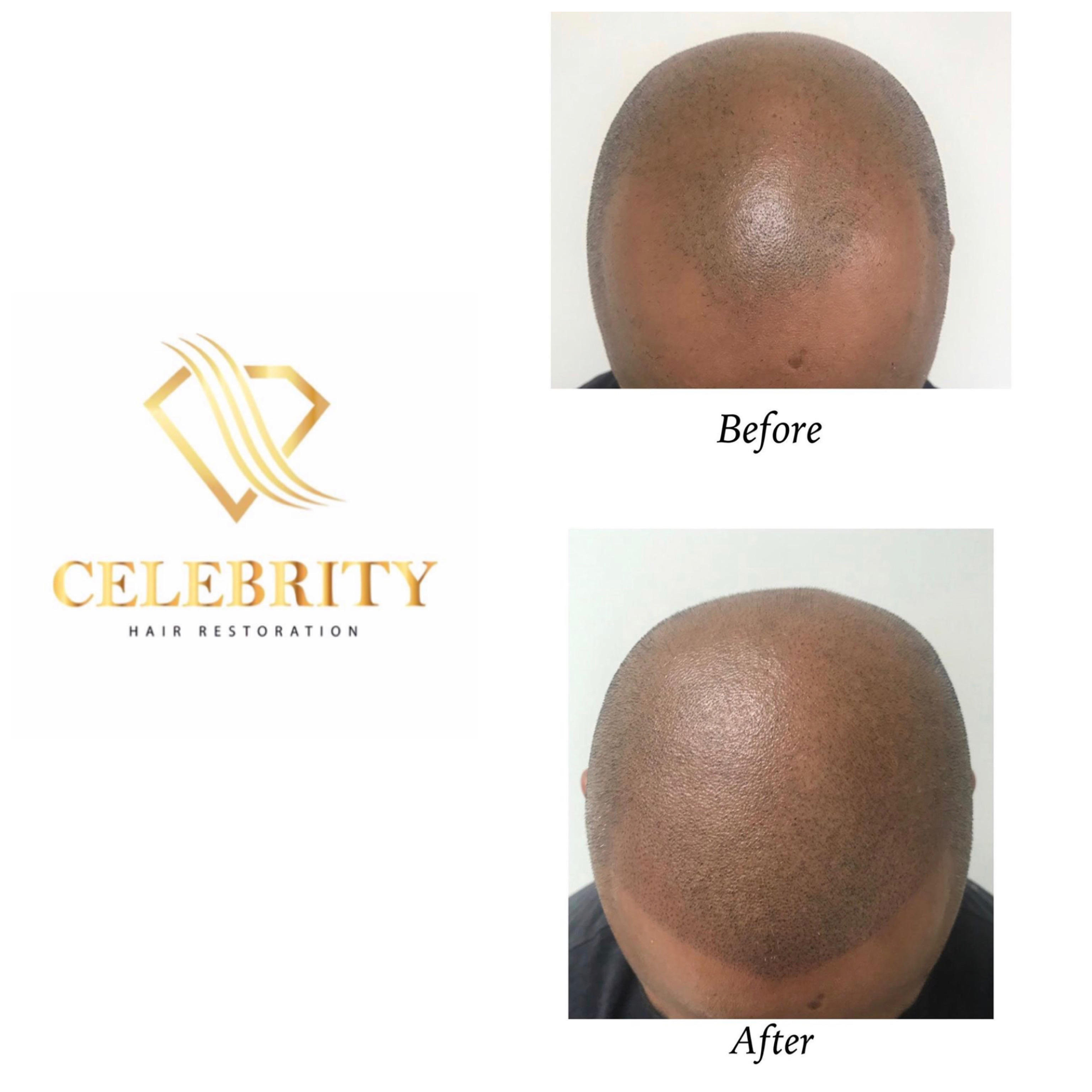 Celebrity Hair Restoration Photo