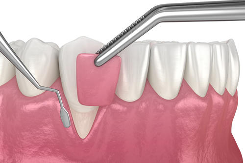 Gum Grafting & Root Coverage