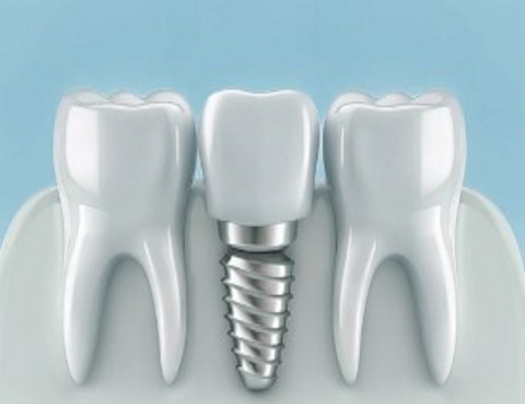 Implants