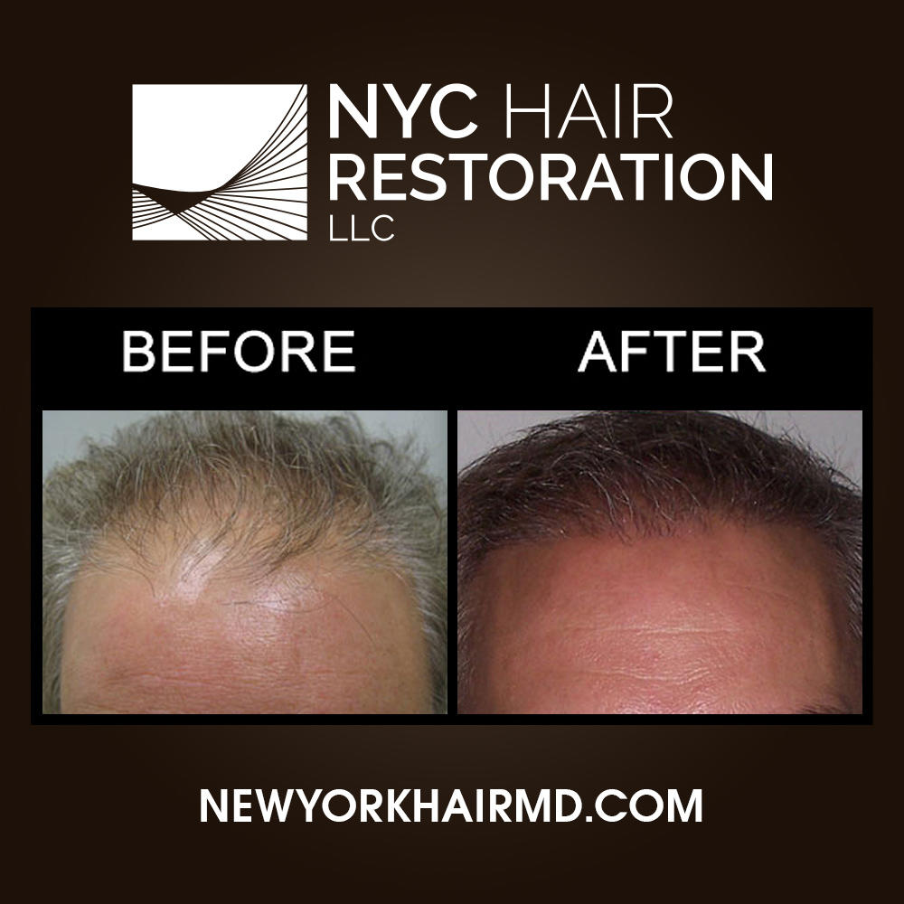 NYC Hair Restoration Photo