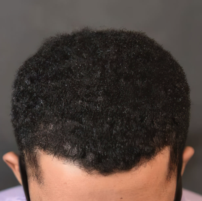 FUE Hair Transplant