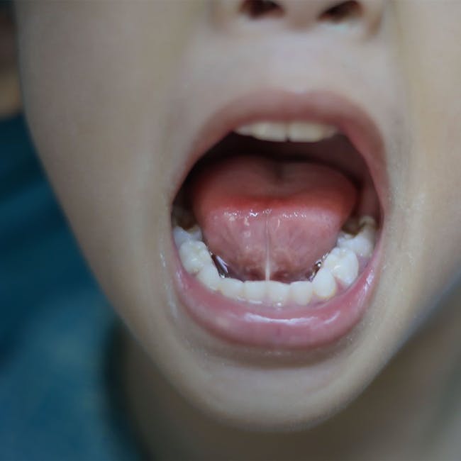 Frenectomy