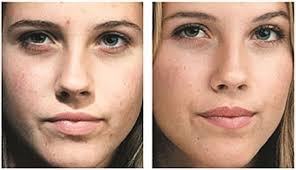Microdermabrasion